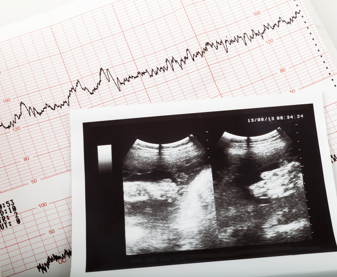 Does Ivf Increase Risk Of Twins